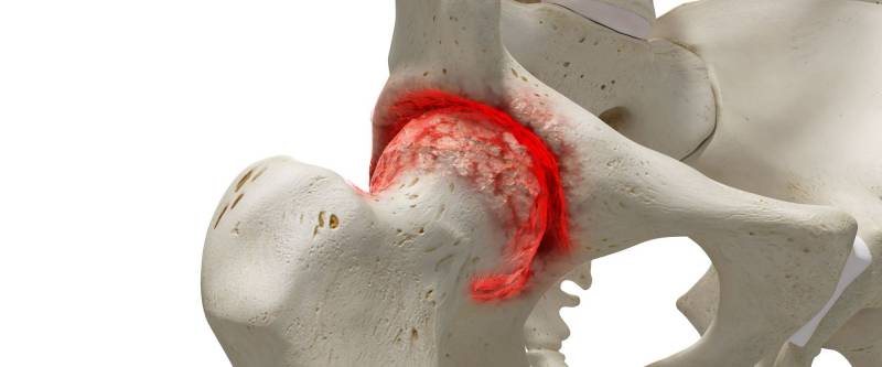 L’artrosi all’anca